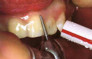 препарирование зуба под винир