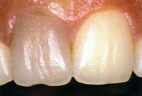 потемнение зуба